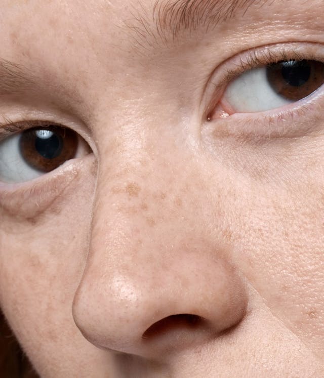 Understanding Hyperpigmentation